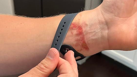 Apple Watch is now causing RASHES as users report irritation | Daily Mail  Online